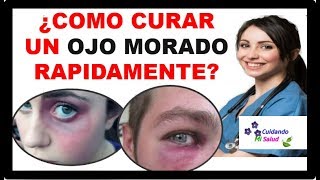 💡 COMO CURAR UN OJO MORADO  3 pasos para tratar y eliminar Moretones o Hematoma facial 2021 ✅ [upl. by Junius]