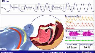 Understanding Sleep Disordered Breathing [upl. by Acinhoj]