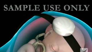 Fetal Distress Ultrasound and Heart Monitor [upl. by Harehs]