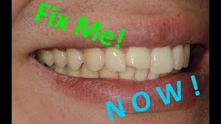 How to fix a broken front tooth the SAME DAY [upl. by Raskind989]