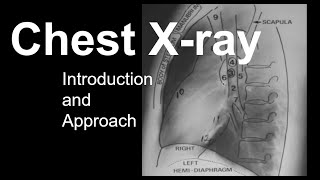 Chest Xray Introduction and Approach [upl. by Barmen]