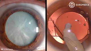 What Its Like To Get Laser Eye Surgery [upl. by Itsirc380]