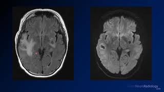 Imaging brain tumors  5  Non glial tumors [upl. by Tiat760]