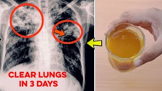 Top 10 Natural Lung Infection Treatments Home Remedies [upl. by Alikahs]