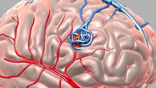 Cerebrovascular Disease [upl. by Emily]