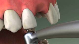 Dentist  Maryland Bridge Procedure [upl. by Edan]