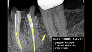 How to extract a lower molar PART 1 [upl. by Anirdnaxela]