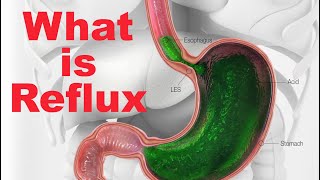 How to set up a reflux reaction [upl. by Hassett]