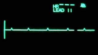 Primary Ventricular Standstill P wave Asystole [upl. by Fonville96]