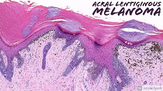 Acral Lentiginous Melanoma Dermatopathology [upl. by Meelas825]