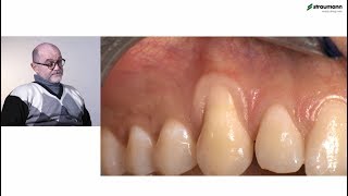 Prof Giovanni Zucchelli Treatment of class I gingival recession [upl. by Woehick]