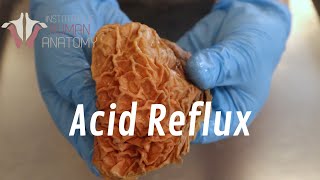 What Is Acid Reflux [upl. by Ducan]