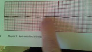 Agonal and Asystole [upl. by Gerianna857]