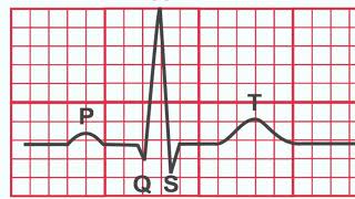 Normal EKG vs Heart Attack [upl. by Shipley650]