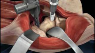 Direct Anterior Approach Hip Replacement [upl. by Nimajnab]