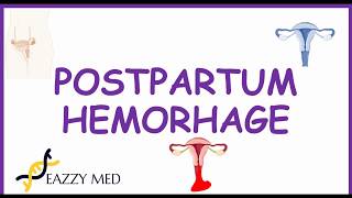 Postpartum Hemorrhage PPH causesrisk factorsprevention and treatment [upl. by Phares49]