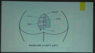 61 Pilonidal Sinus  Dr Lalit Aggarwal [upl. by Auof]