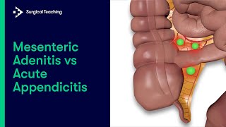 Mesenteric Adenitis vs Appendicitis  How to tell the difference [upl. by Donovan]