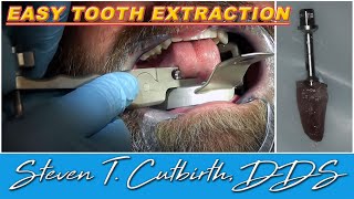 Easy Tooth Extraction  Dental Minute with Steven T Cutbirth DDS [upl. by Heida]