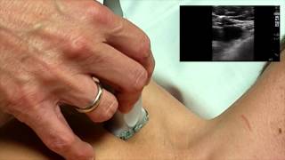 How To Ultrasound Guidance for Central Venous Access Part 1 Case Study [upl. by Faun187]