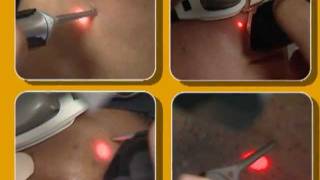 Laser Hair Removal video by Cynosure [upl. by Courcy]