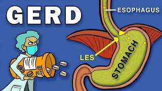 Gastroesophageal Reflux Disease GERD [upl. by Reivax479]