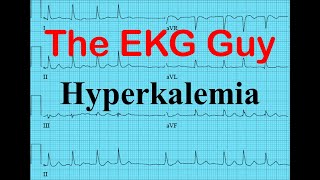 EKGECG  Hyperkalemia  The EKG Guy  wwwekgmd [upl. by Vierno889]