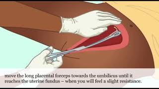 Postpartum IUD A Practical Guide [upl. by Navoj995]