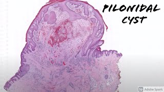 Pilonidal cystsinustract 5Minute Pathology Pearls [upl. by Aicinad749]