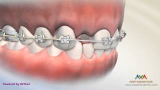 Orthodontic amp Restorative Treatment for Missing Lateral Incisor  Different Options [upl. by Basile]