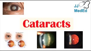 Cataracts  Causes Risk factors Subtypes Cortical Nuclear Posterior subcapsular Treatment [upl. by Craig714]