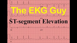 EKGECG STsegment Elevation  Question 90  The EKG Guy [upl. by Annuahs]