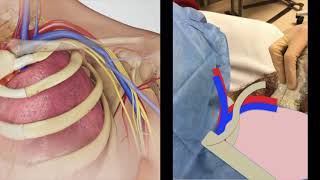 EEM 2019 Central line placement with EMCrit [upl. by Bouzoun338]