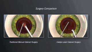 Erbium YAG laser skin resurfacing [upl. by Gnav]