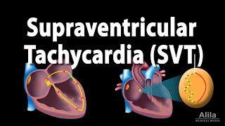 Supraventricular Tachycardia SVT PSVT Animation [upl. by Iphlgenia433]