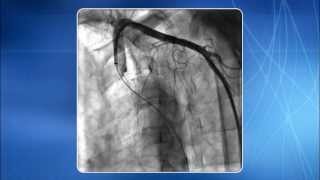 Left Subclavian artery stenting through LRA [upl. by Stearns]