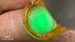 Laser Zaps Out Ingrown Hairs  Art Insider [upl. by Neellok970]