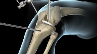 Knee ACL injury mechanics  Injury mechanism [upl. by Naji]