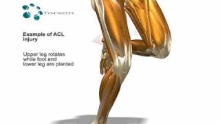 ACL Tear Sports Injury [upl. by Zimmer84]