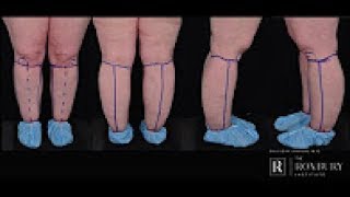 Stages of Lymphedema [upl. by Gut]