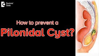 Pilonidal cyst prevention Can a pilonidal cyst grow back  Dr Rajasekhar M R [upl. by Saville]