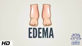 Edema Causes Signs and Symptoms Diagnosis and Treatment [upl. by Leontine]