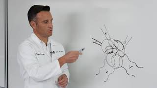 Arteriovenous Malformation AVM explained by Dr M Ravikumar  Consultant Neurosurgeon [upl. by Eidnar]