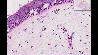 Histopathology Nose Nasal polyp [upl. by Baptiste]