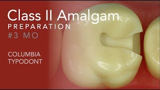 Class II Amalgam Preparation 3 MO [upl. by Nahshu]