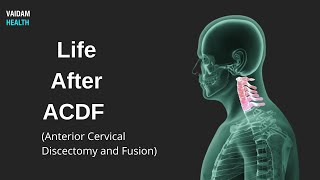 Life After ACDF Anterior Cervical Discectomy and Fusion [upl. by Kaiser]