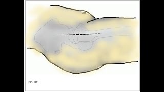 Hardinge Approach  Lateral Approach to the Hip [upl. by Bonni]